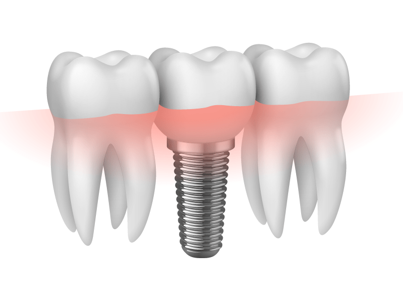 dental implants doncaster